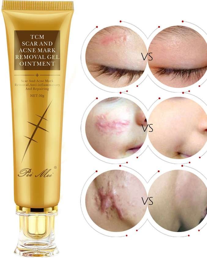 TCM Scar Removal Cream, Scar Reducing Treatment, Scar Remover Gel for Stretch Mark, Acne Scar, Spots, Surgical Scars, Burns, Cuts and C Section Scar 1