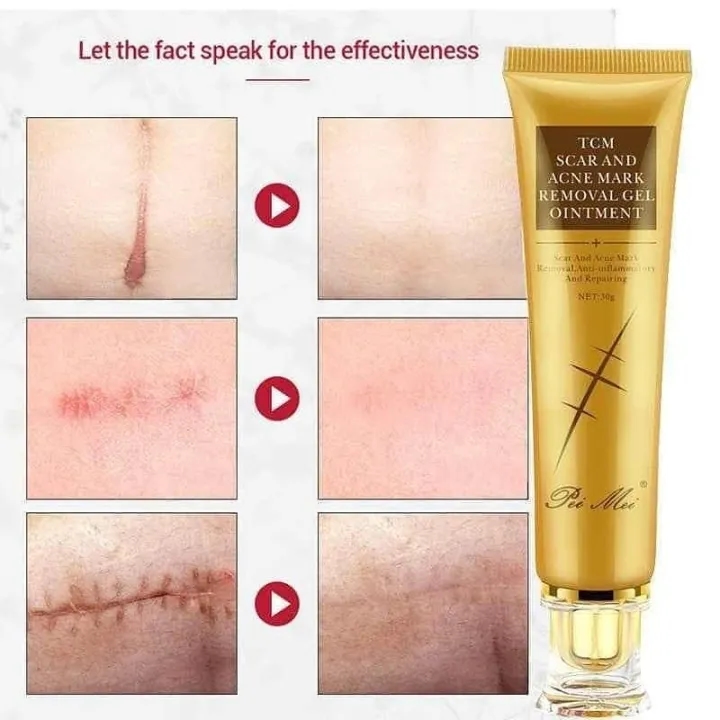 TCM Scar Removal Cream, Scar Reducing Treatment, Scar Remover Gel for Stretch Mark, Acne Scar, Spots, Surgical Scars, Burns, Cuts and C Section Scar 3