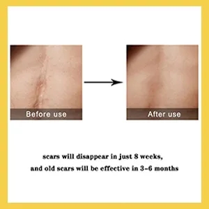 TCM Scar Removal Cream, Scar Reducing Treatment, Scar Remover Gel for Stretch Mark, Acne Scar, Spots, Surgical Scars, Burns, Cuts and C Section Scar 7