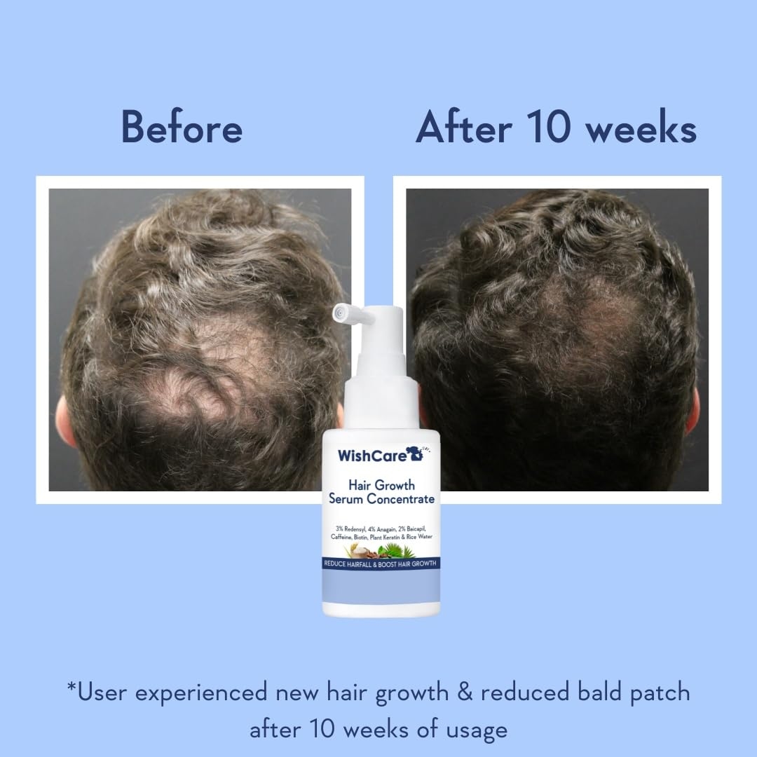 WishCare Hair Growth Serum Concentrate - 3% Redensyl, 4% Anagain, 2% Baicapil, Caffeine, Biotin, Plant Keratin & Rice Water - Hair Growth Serum for Men & Women - 30ml 3