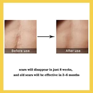 TCM Scar Removal Cream, Scar Reducing Treatment, Scar Remover Gel for Stretch Mark, Acne Scar, Spots, Surgical Scars, Burns, Cuts and C Section Scar 6