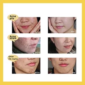 TCM Scar Removal Cream, Scar Reducing Treatment, Scar Remover Gel for Stretch Mark, Acne Scar, Spots, Surgical Scars, Burns, Cuts and C Section Scar 7