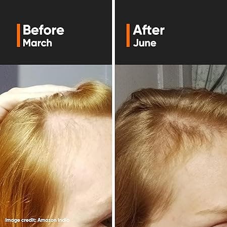 Minimalist Hair Growth Serum With 3% Redensyl, 3% Anagain, 3% Procapil, 5% Capixyl & 4% Baicapil 18% Hair Growth Actives | For Hair Fall Control | For Men & Women | 30 ml 1