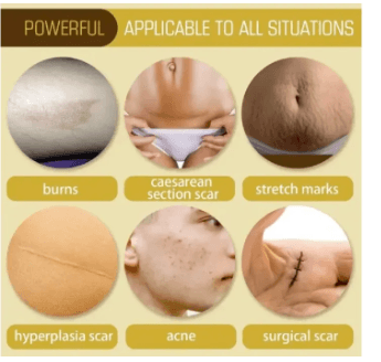 Scar Removal Cream - TCM Scar Serum for Surgical Scars, Acne Skin Care Cream, Acne Treatment Cream for Scars, Burns, Stretch Marks, Acne Spots 30Gm 1