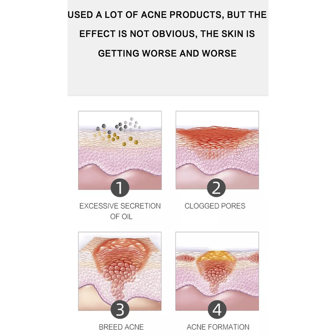 Dr. Rashel Aloe Vera Anti-Acne Pimple Cream Repair Acne Scars 2