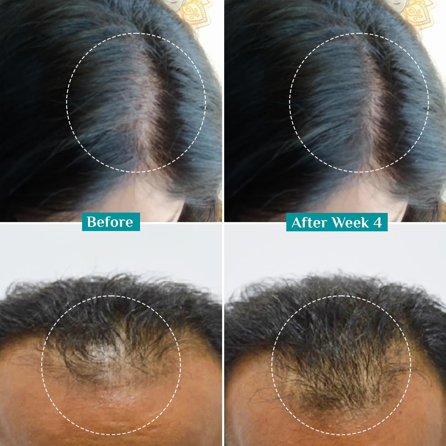 Pilgrim Redensyl 3% + Anagain 4% Advanced Hair Growth Serum (100ml) with Korean Black Rice, Controls Hair Fall, Stimulates Hair Growth, Increase Hair Density | HairGrowth Serum for Men & Women 2