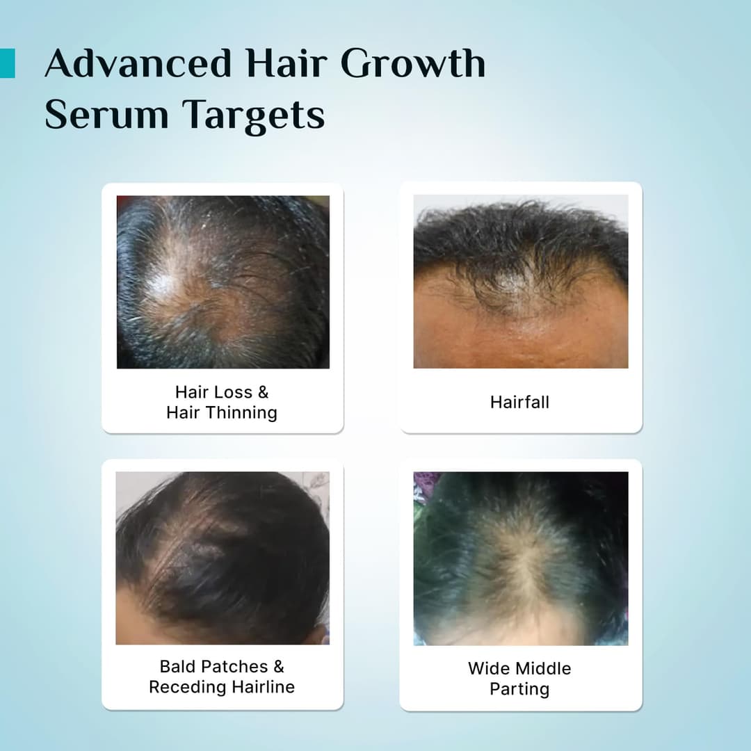 PILGRIM Redensyl 3%+Anagain 4% Advanced Hair Growth Serum For Scalp | 50 ml | With Natural Ingredients Korean Black Rice Controls Hair Fall Stimulates Increases Hair Density | Hairgrowth Serum For Unisex 5