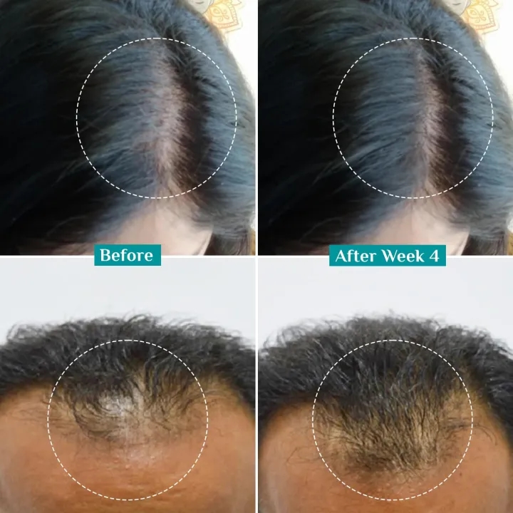 PILGRIM Redensyl 3%+Anagain 4% Advanced Hair Growth Serum For Scalp | 50 ml | With Natural Ingredients Korean Black Rice Controls Hair Fall Stimulates Increases Hair Density | Hairgrowth Serum For Unisex 2