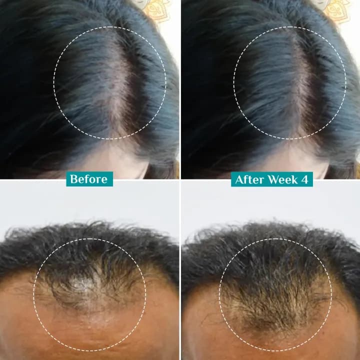 PILGRIM Redensyl 3%+Anagain 4% Advanced Hair Growth Serum For Scalp | 50 ml | With Natural Ingredients Korean Black Rice Controls Hair Fall Stimulates Increases Hair Density | Hairgrowth Serum For Unisex 1